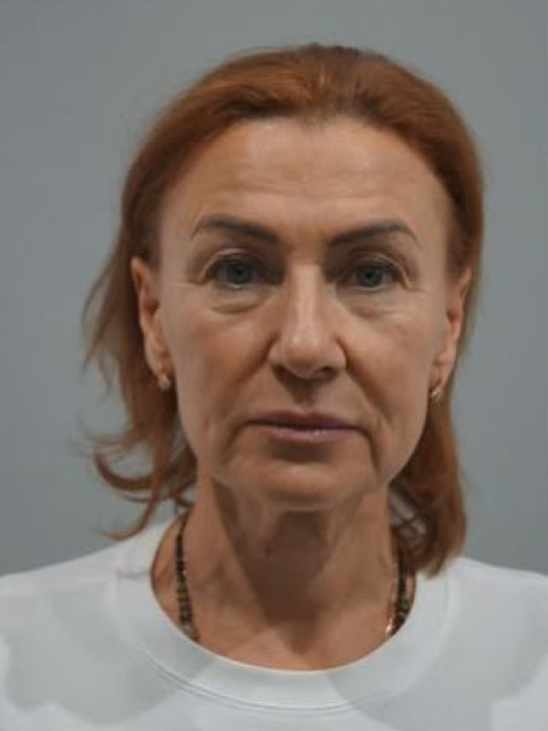 До: Эндоскопическая подтяжка лба и средней зоны лица
